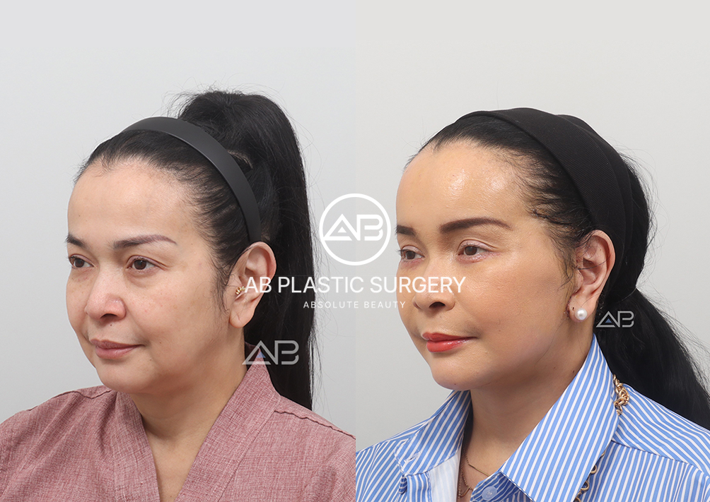 Foto Sebelum dan Sesudah Face Lifting di Korea