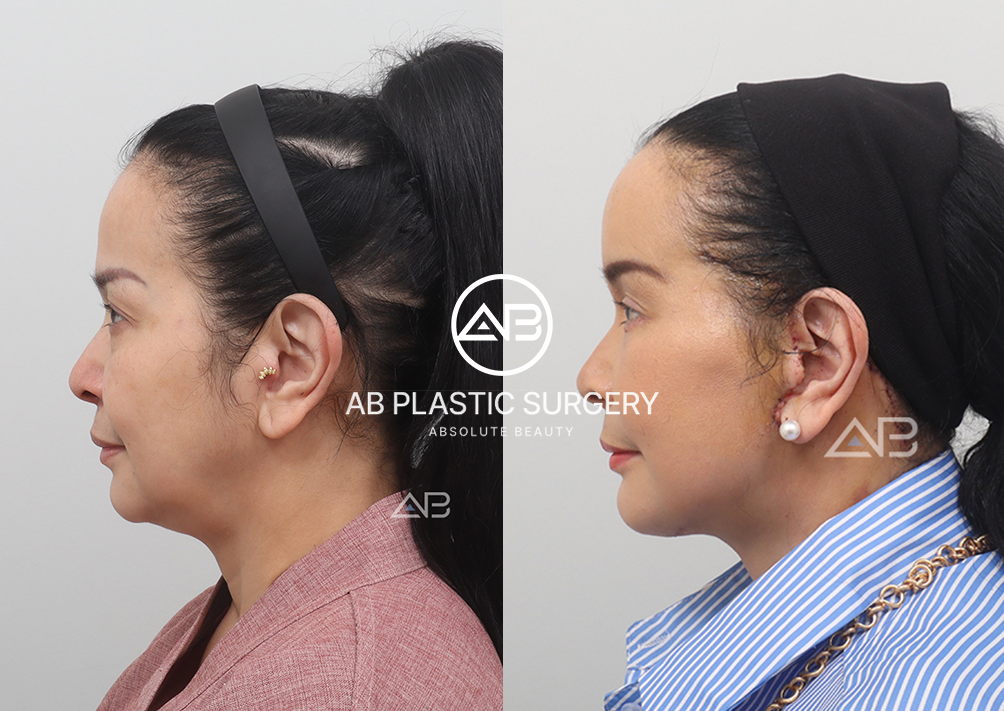 Foto Samping Sebelum dan Sesudah Face Lifting di Korea