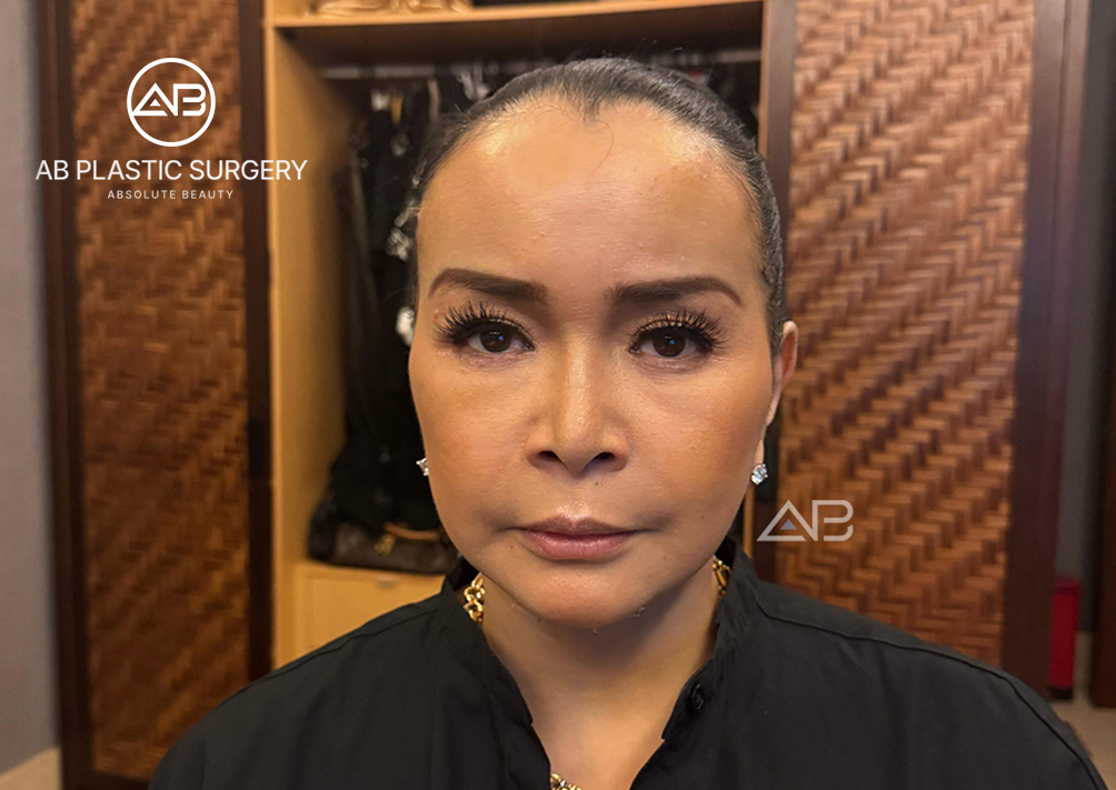 2 Minggu Setelah Face Lifting di AB Operasi Plastik Korea