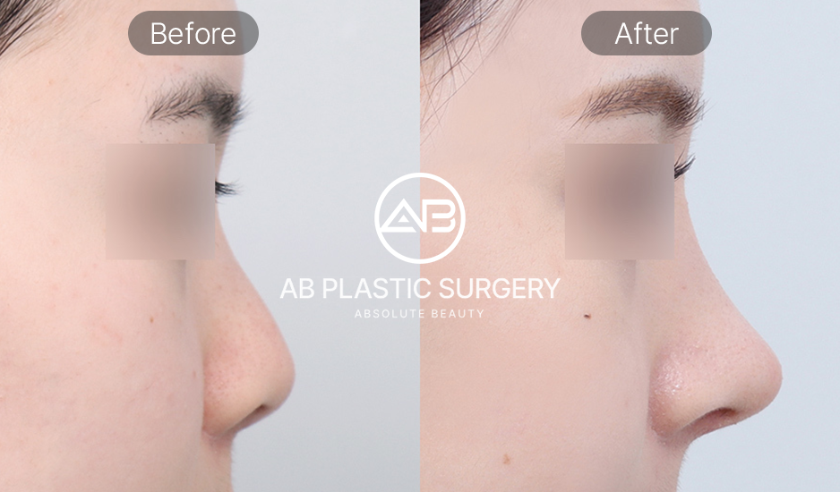 Foto Perbandingan Sebelum dan Sesudah Operasi Hidung Korea