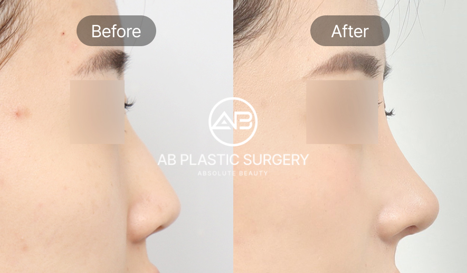 Foto Perbandingan Sebelum dan Sesudah Operasi Hidung di Korea