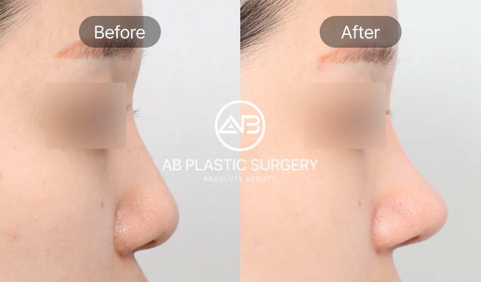 Contoh Keberhasilan Operasi Hidung di Korea