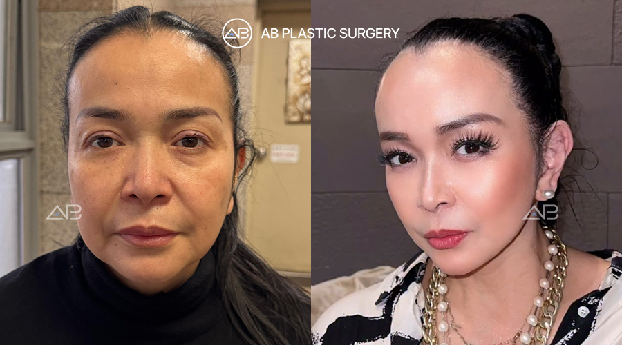 Jennifer Jill before and after facelift plastic surgery in Korea