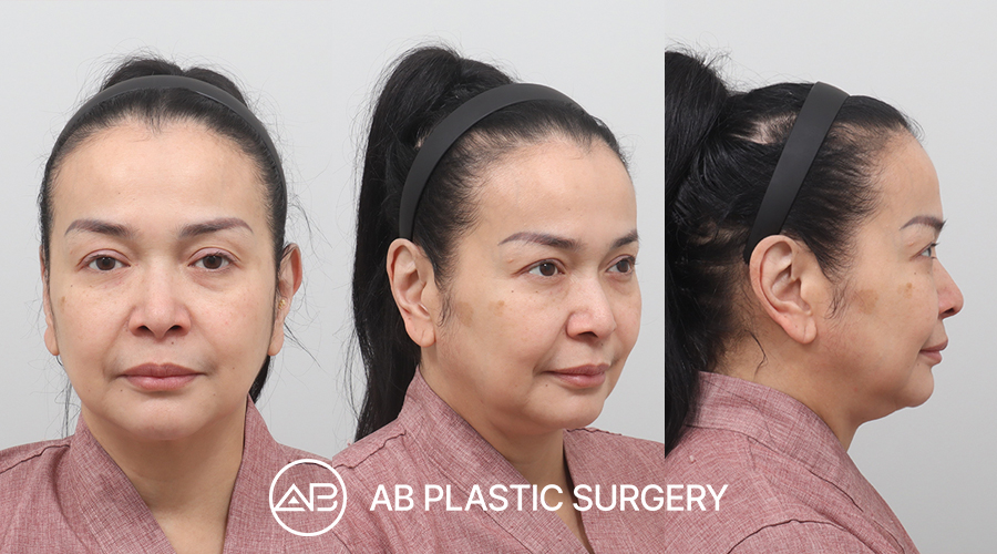 Foto sebelum facelift Jennifer Jill di AB Plastic Surgery Korea