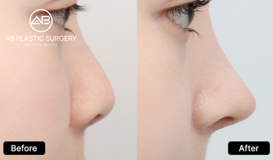 Perbandingan sebelum dan sesudah operasi hidung di AB Plastic Surgery Korea