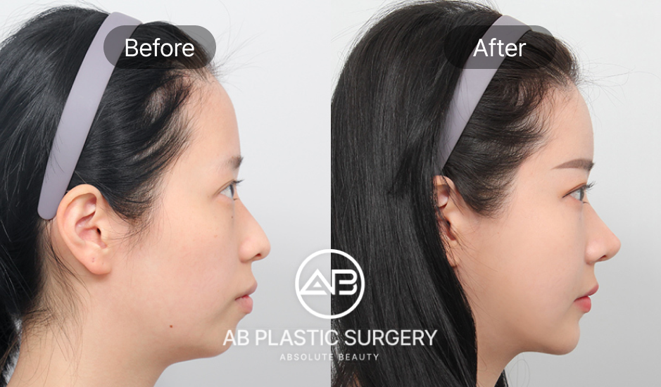 Perbandingan hasil sebelum dan sesudah operasi wajah di AB Plastic Surgery Korea