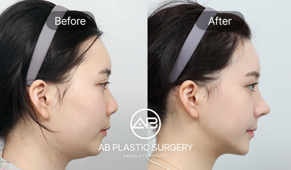 Perbandingan sebelum dan sesudah operasi hidung dengan tulang rawan autologus di Operasi Plastik AB Korea