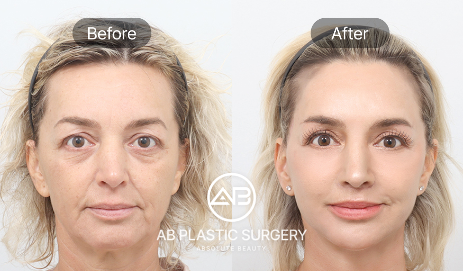 Sebelum dan sesudah operasi anti-aging Full SMAS lifting di Operasi Plastik AB Korea