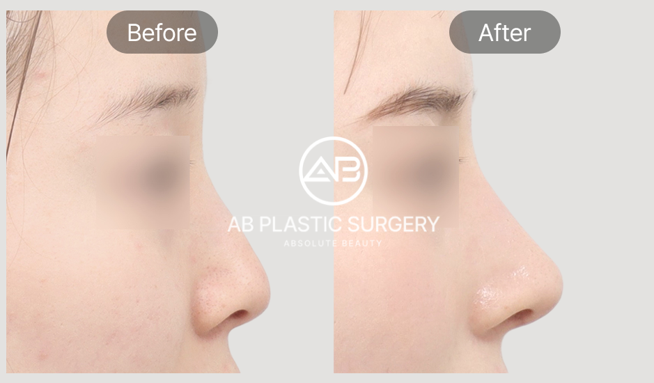 Gambar before after revisi hidung di AB Plastic Surgery Korea dari tampak samping