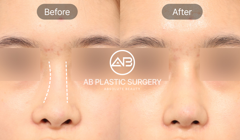 Gambar before after revisi hidung bengkok (deviasi) di AB Plastic Surgery Korea