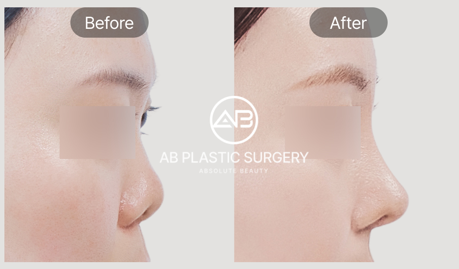 Gambar before after revisi hidung karena kontraktur dan implan tembus di AB Plastic Surgery Korea