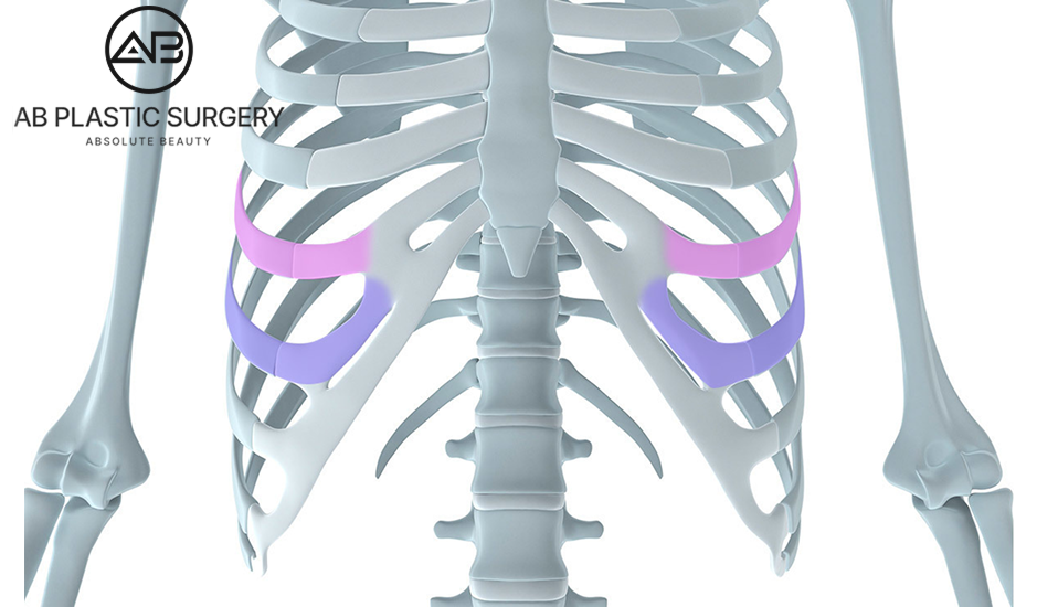 Ilustrasi lokasi pengambilan tulang rawan iga untuk revisi hidung di AB Plastic Surgery Korea
