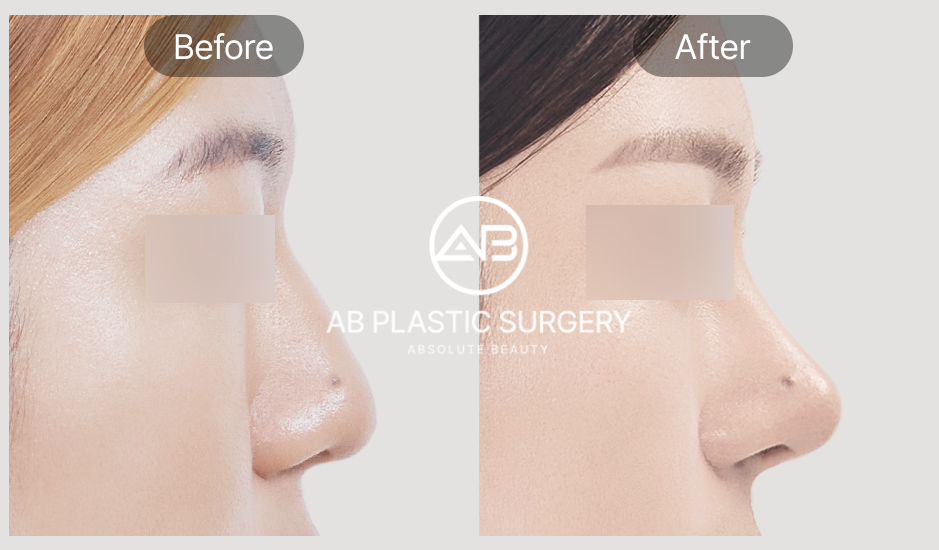 Gambar before after hasil revisi hidung pasca pemulihan di AB Plastic Surgery Korea