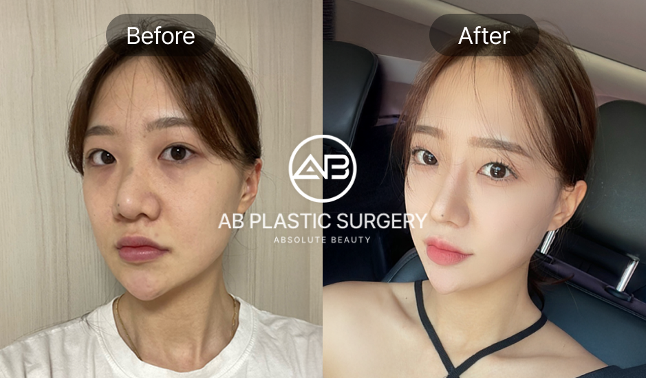 foto sebelum dan sesudah revisi hidung di Operasi Plastik AB Korea