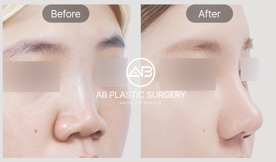 Gambar before after kasus revisi hidung bengkok dan kontraktur di AB Plastic Surgery Korea