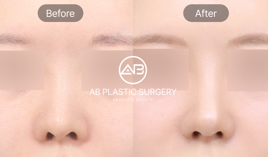 Gambar before after revisi hidung karena implan tembus dan kulit tipis di AB Plastic Surgery Korea