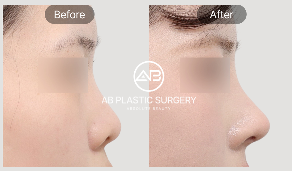 Gambar before after revisi hidung terangkat (short nose) di AB Plastic Surgery Korea