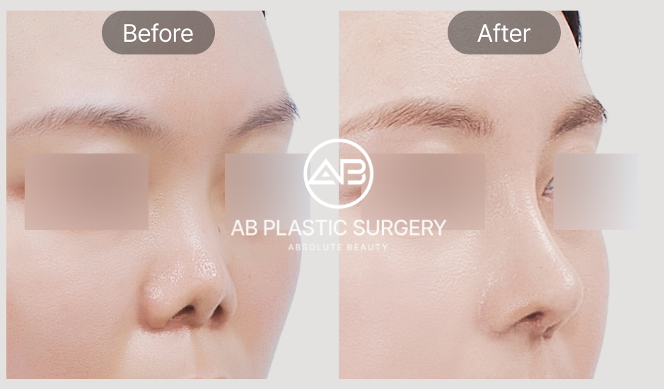 Gambar before after revisi hidung dengan hasil alami dan simetris di AB Plastic Surgery Korea