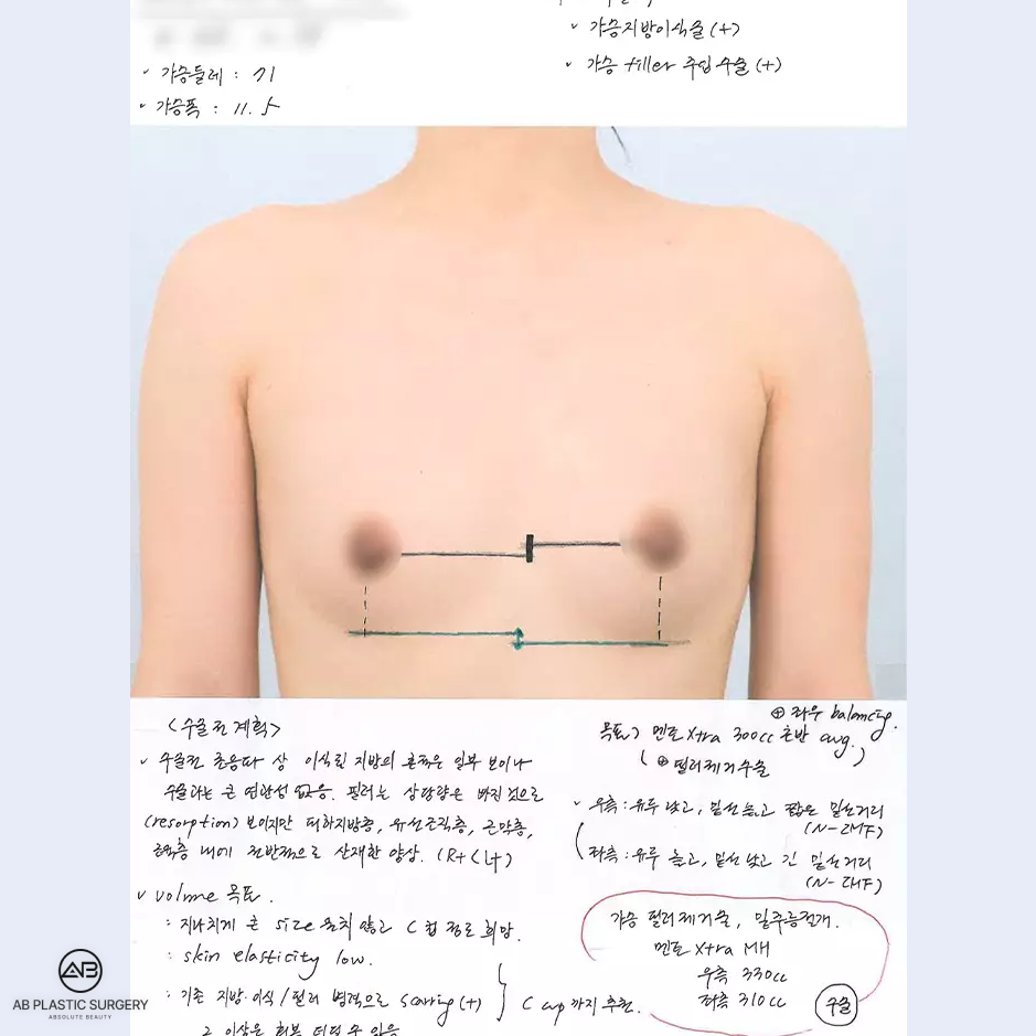 Perencanaan desain sebelum operasi pembesaran payudara di Operasi Plastik AB Korea