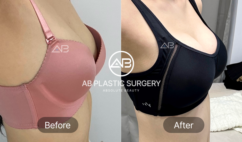 Before-after operasi implan payudara di Operasi Plastik AB Korea