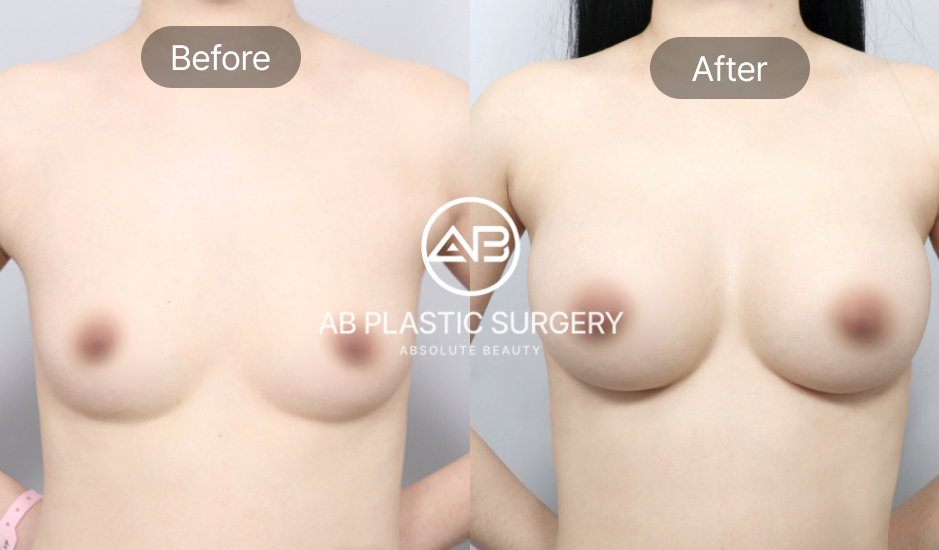 Hasil before-after operasi implan payudara di Operasi Plastik AB Korea