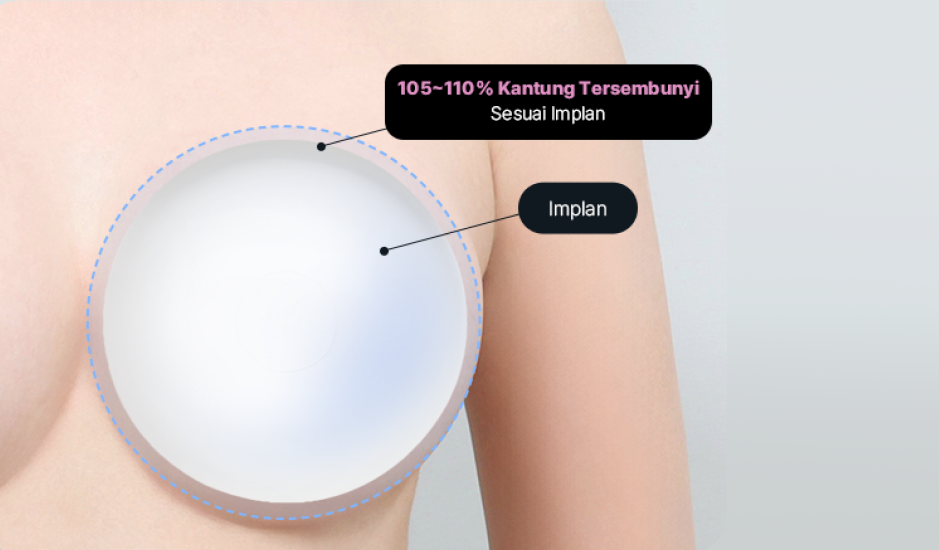 Ilustrasi penempatan kantung implan payudara 105~110%