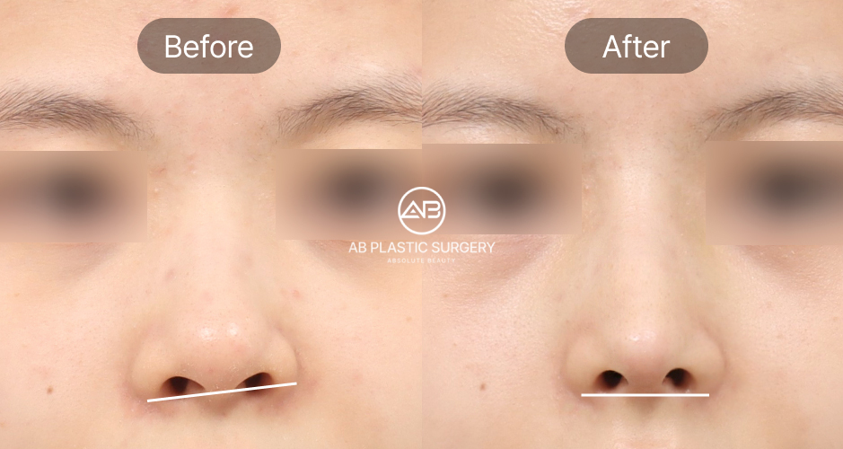 Before after hasil operasi koreksi hidung miring di Operasi Plastik AB Korea
