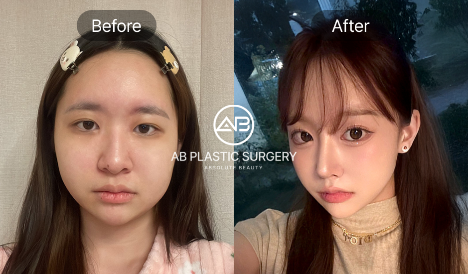 Transformasi wajah setelah koreksi hidung miring di Operasi Plastik AB Korea