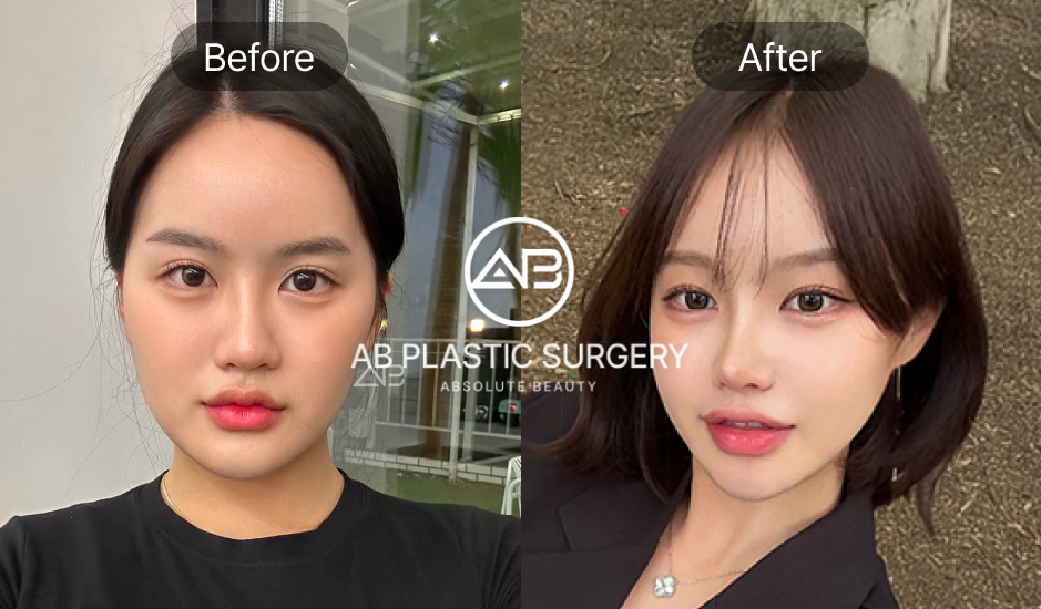 Perubahan wajah alami setelah koreksi hidung miring di AB Korea