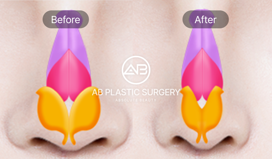 Struktur anatomi hidung miring sebelum dan sesudah koreksi di Operasi Plastik AB Korea