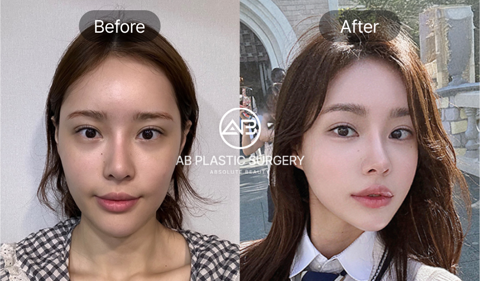 Before-after koreksi hidung miring – hasil alami dan simetris dari Operasi Plastik AB Korea