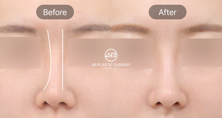 Garis hidung bengkok sebelum dan sesudah koreksi – kasus hidung miring di AB Korea