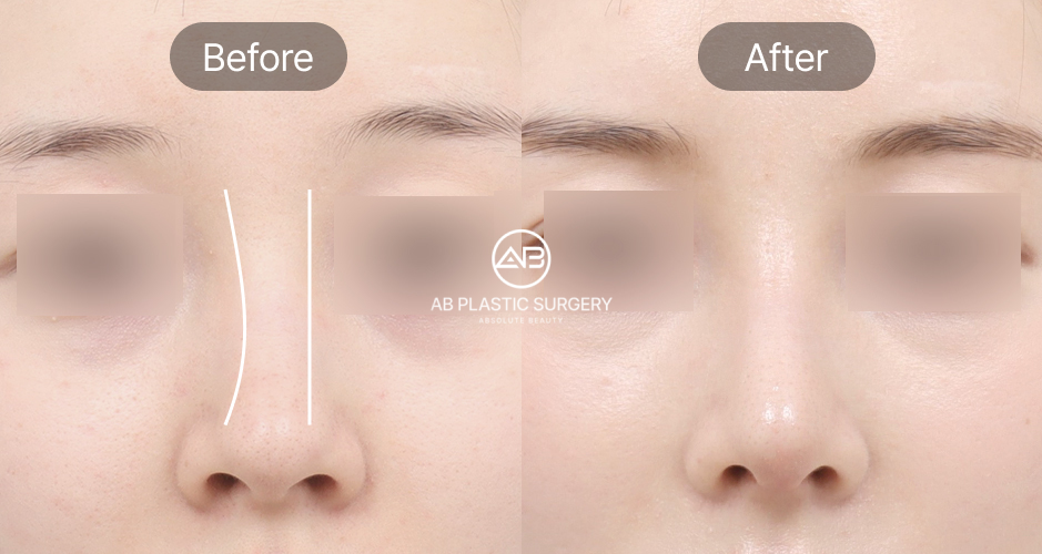 Perbandingan garis hidung miring sebelum dan sesudah koreksi di AB Korea