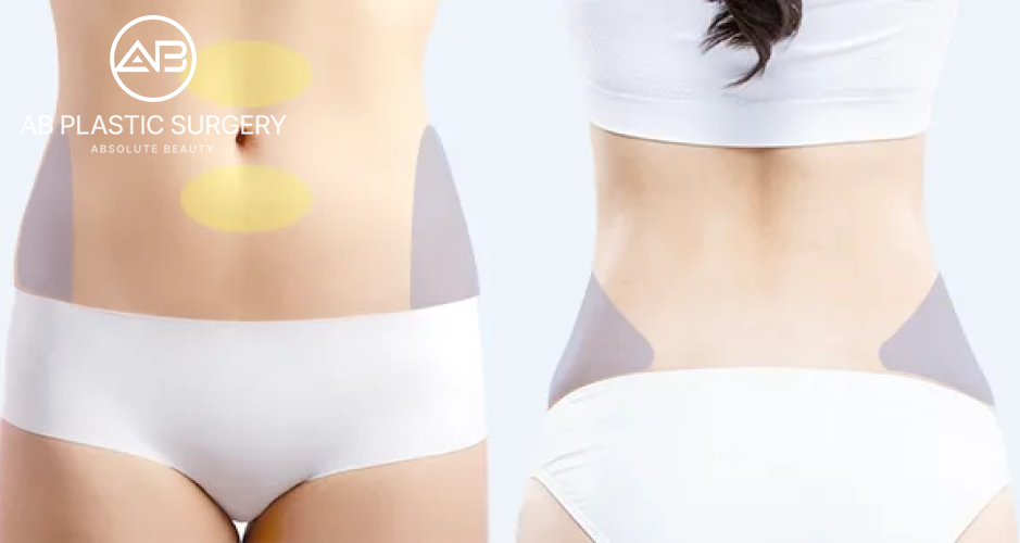 Ilustrasi area tubuh yang bisa dilakukan sedot lemak di Operasi Plastik AB Korea, termasuk perut dan pinggang, prosedur liposuction untuk pembentukan tubuh sesuai kebutuhan