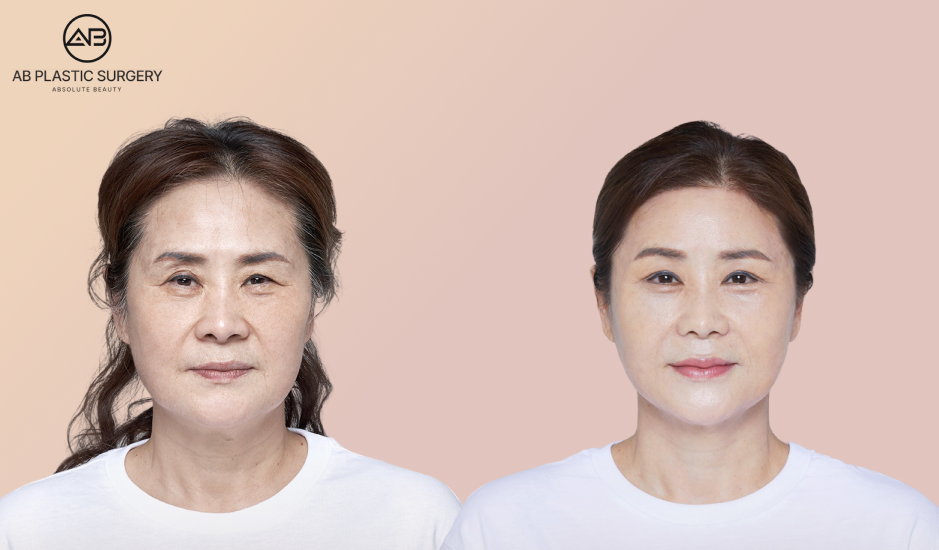 Sebelum dan sesudah tanam benang untuk facelifting di Operasi Plastik AB Korea, hasil pengencangan kulit wajah terlihat lebih muda dan kencang