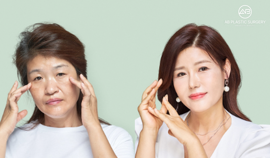Proses tanam benang untuk facelifting di Operasi Plastik AB Korea, hasil kulit wajah lebih kencang dan tampak muda