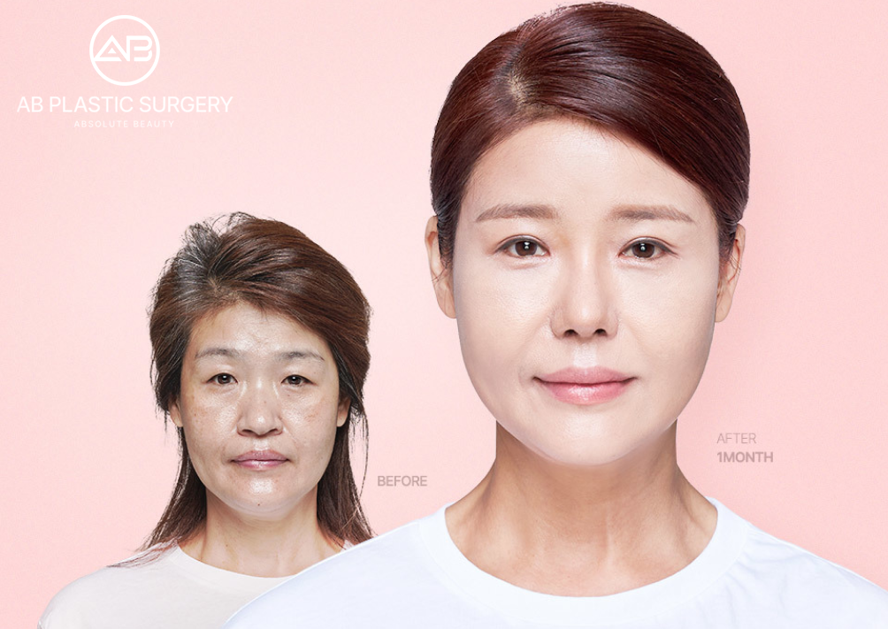 Hasil sebelum dan sesudah tanam benang facelifting di Operasi Plastik AB Korea, perubahan tampak jelas setelah 1 bulan