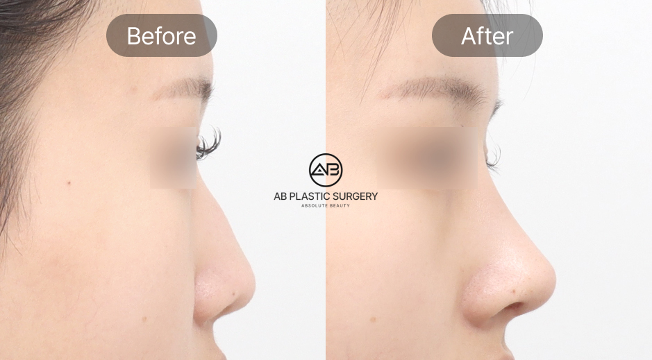 Foto sebelum dan sesudah operasi plastik hidung pesek di Operasi Plastik AB Korea, perbandingan bentuk hidung setelah koreksi