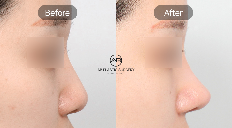 Foto sebelum dan sesudah operasi plastik hidung terlalu pesek di Operasi Plastik AB Korea, perbandingan bentuk hidung setelah diperbaiki agar lebih proporsional