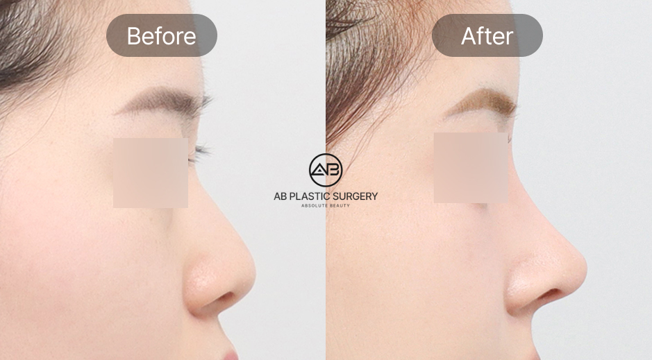 Foto sebelum dan sesudah operasi plastik ujung hidung turun di Operasi Plastik AB Korea, perbandingan hasil koreksi agar lebih natural dan proporsional