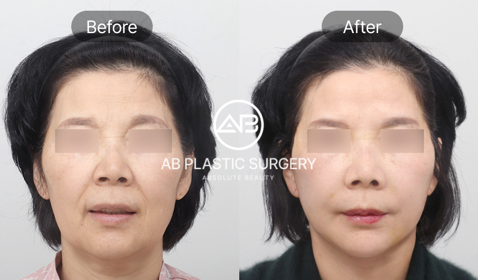 Sebelum dan sesudah tanam benang facelifting di Operasi Plastik AB Korea untuk pasien usia 50 tahun ke atas, kulit wajah tampak lebih kencang