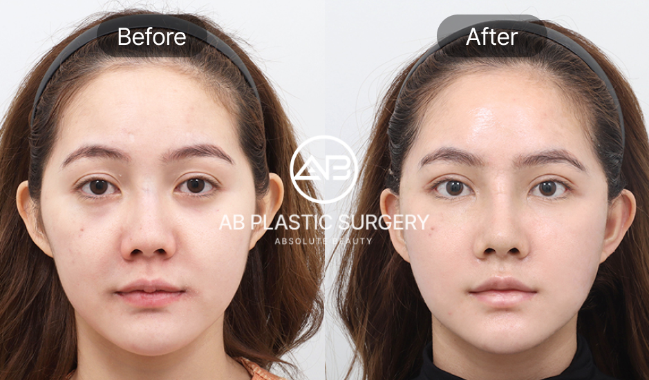 Sebelum dan sesudah tanam benang facelifting di Operasi Plastik AB Korea pada kulit dengan elastisitas baik, wajah lebih kencang dan segar