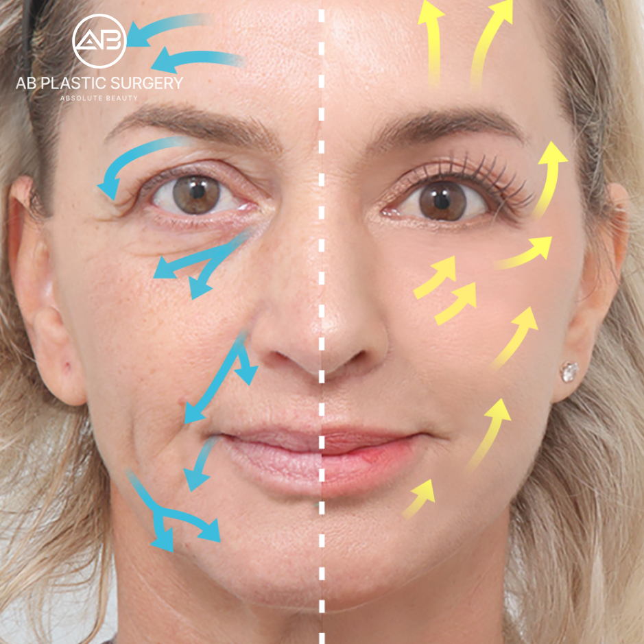 Ilustrasi perbandingan arah tarikan sebelum dan sesudah prosedur thread lift dan facelift.