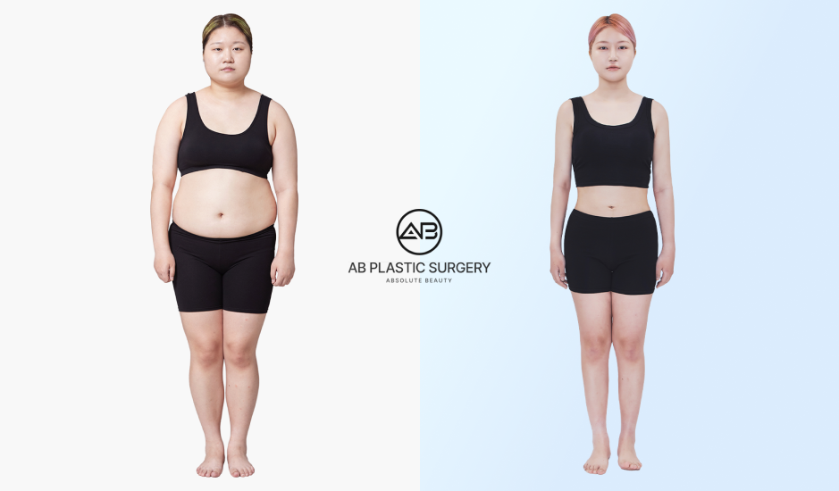 Before after sedot lemak perut di Operasi Plastik AB Korea
