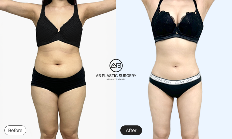 Foto sebelum dan sesudah sedot lemak perut wanita size 66 di Operasi Plastik AB Korea.