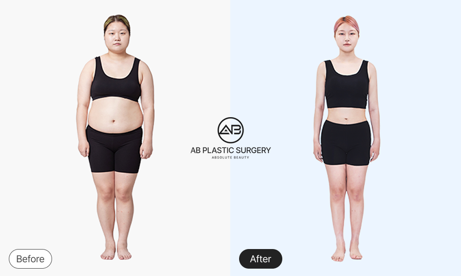 Foto sebelum dan sesudah sedot lemak perut wanita size 77 di Operasi Plastik AB Korea