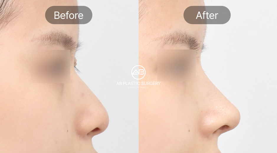 before after operasi hidung tanpa implan korea, hasil operasi hidung alami tanpa implan di Operasi Plastik AB Korea, perubahan hidung sebelum dan sesudah, hidung mancung natural korea