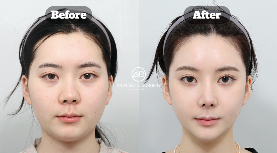 Hasil sebelum dan sesudah operasi kontur wajah di AB Plastic Surgery Korea