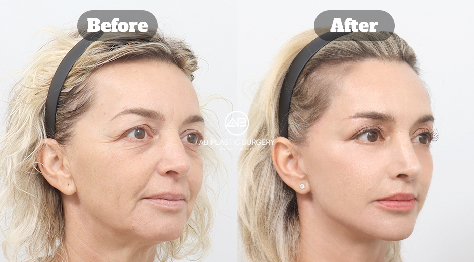 Before and after full face lifting, neck lifting, operasi kelopak mata atas dan bawah, serta transplantasi lemak wajah di Korea