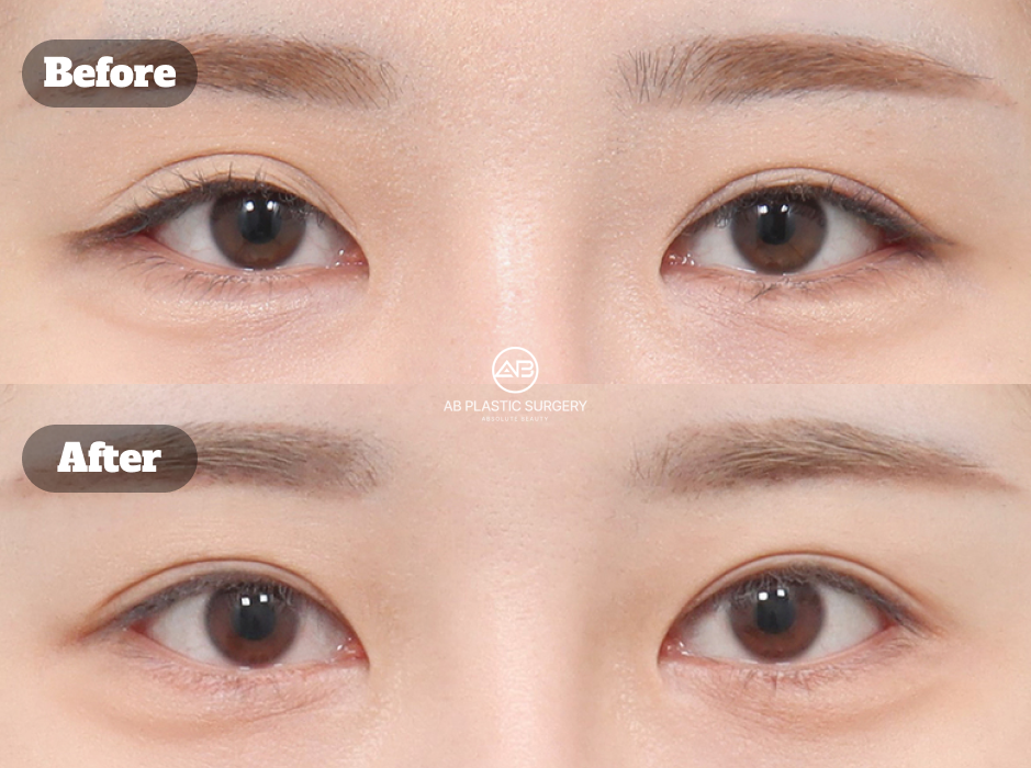 Foto sebelum dan sesudah koreksi mata sayatan dan revisi mata di Korea